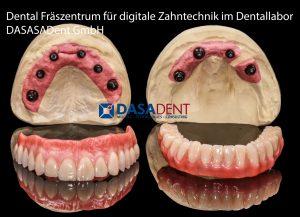 implantat_technik_straumann_dental_fraeszentrum_fuer_digitale_zahntechnik_teleskop_prothese_implantat_abutment_dasadent_fraeszentren_1600